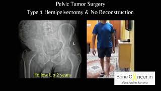 Treatment for Bone Cancer Chondrosarcoma Pelvic Tumour SurgeryHemipelvectomy Dr Srimanth B S [upl. by Arihk151]