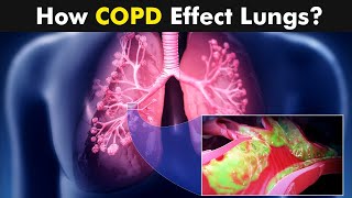 Chronic Obstructive Pulmonary Disease COPD  Symptoms Causes And Treatment UrduHindi [upl. by Roger]