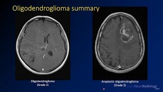 Imaging brain tumors  3  Oligodendrogliomas [upl. by Ryter969]