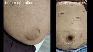 Umbilical Hernia and Morbid Obesity Laparoscopic surgery [upl. by Soalokcin]