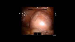 simple myomectomy using the robot [upl. by Hebbe]