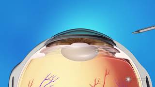 What is Refractive Lens Exchange Surgery [upl. by Sirromed]