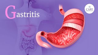 What is Gastritis  Causes Symptoms Complications and Treatment  CARE Hospitals [upl. by Leafar]