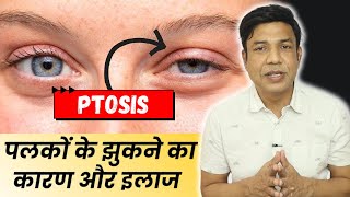 Ptosis of the Eye What You Need to Know Don’t Miss Out🔥 [upl. by Burtie247]