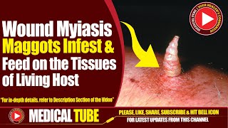 Wound Myiasis  Causes Symptoms Diagnosis And Treatment  Medical Tube [upl. by Attelrac649]