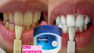 Turn dirty yellow teeth to White in just 3 minutes [upl. by Craggy937]