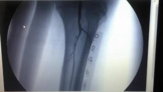 Angioplastia miembro inferior izquierdo [upl. by Orlanta]