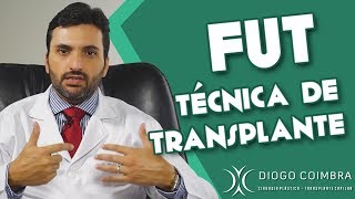 Transplante Capilar Como é Feito FUT [upl. by Kristan]