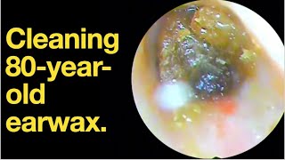 Cleaning 80yearold earwax ear wax removal  ear cleaning  ASMR  relaxation  relax [upl. by Slade525]