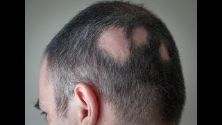 Alopecia areata Treatment  Intralesional Corticosteroid InjectionBy Dr sunny Rajput [upl. by Adnawed410]