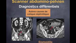 Lithiase Urinaire  3 Diagostics différentiels [upl. by Sinaj]