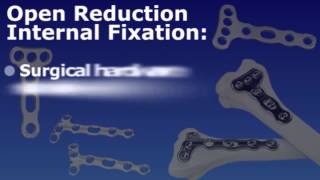 Wrist Fracture  Open Reduction and Internal or External Fixation [upl. by Etnauj892]