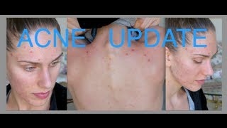 Acne Update For Acne Awareness Month Sunscreen Skincare Routine Summer amp Herbal Supplements [upl. by Tait]