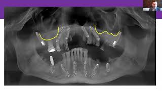 AO 2021 BioXclude Corporate Forum Dan Holtzclaw DDS MS [upl. by Sue]