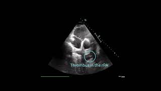 〖Echocardiography〗 Acute pulmonary embolism with a thrombus in the right pulmonary artery 🏥 [upl. by Hazem904]