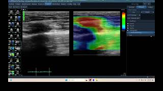 IQ 322 TFAST LUNG ULTRASOUND ECHOPAC ANALYSIS ELASTOGRAPHYFELINE AORTIC THROMBOEMBOLISM [upl. by Htebarual]