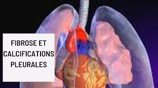 Fibrose et calcifications pleurales [upl. by Nogam]