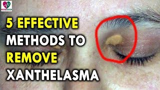 5 Effective Methods to Remove Xanthelasma  Best Health Tips for CHRONIC DISEASES [upl. by Ainek]