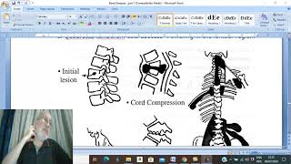 Orthopedic in Arabic 51  Potts Disease  pathology   by DrWahdan [upl. by Shutz]