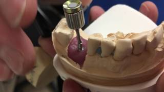 Neodent implant placed on an angle NeoDent tryin abutment kit 17 degree angulated abutment [upl. by Nomed841]