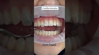 Carillas dentales carillasdentales esteticadental parati sonrisaperfecta carillas fypシ゚viral [upl. by Anyt]