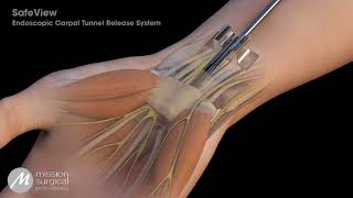 SafeView Endoscopic Carpal Tunnel Release Animation [upl. by Naujtna]