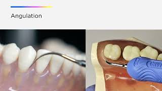 Optimize your Cavitron® Ultrasonic Technology The Three A’s of Ultrasonic Instrumentation [upl. by Arvid]