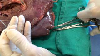 4 Liver Biopsy B [upl. by Esaj]