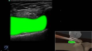 How to Ultrasound Guided Injection of the Lateral Knee 3D Video [upl. by Stasny]