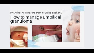 What is an umbilical granuloma How do we manage the umbilical granuloma umbilicalgranuloma [upl. by Irrac]