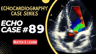 ECHO CASE 89  Echocardiography Case Series  Echocardiogram Interpretation  2D Echo Basics [upl. by Queri703]