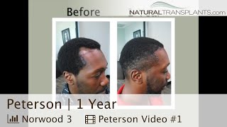 1 Year Check In with Norwood 3 Patient Incredible Results  Dr Siegel Peterson [upl. by Tnirb]