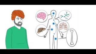 Cancer Basics – What is metastatic cancer [upl. by Sarah]