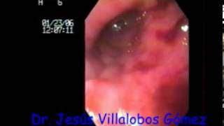 Duodenitis erosiva severa titulo Jesus Villalobosmpg [upl. by Asilanom898]