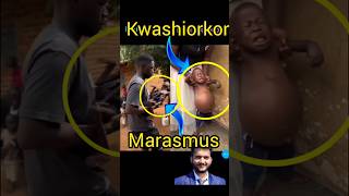 Kwashiorkor and marasmus shorts pna1 [upl. by Marih]