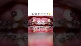 How do Braces work short [upl. by Ocicnarf]