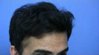 Hair Transplant by Dr Hasson  4200 Grafts  1 Session [upl. by Ahseina]