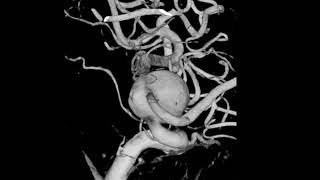 Large Fusiform Aneurysms of ICA flow diverter treatment [upl. by Ylekalb]