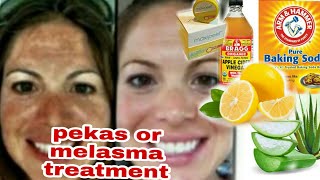 Home Remedies for Melasma or Pekas  Apple Paguio7 [upl. by Nomaj]