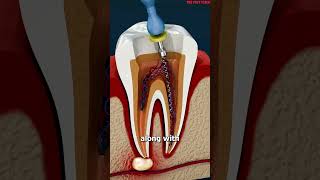 What Is A Root Canal 😳facts shorts youtubeshortsshortsvideo reels [upl. by Ahseem154]