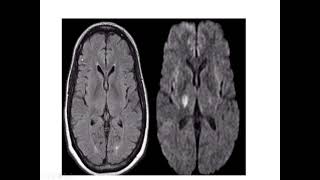 MRI sequences [upl. by Ellened]