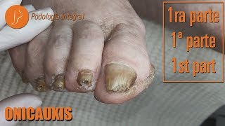 Onicauxis onychomycosis amp callosities Part 1 podologiaintegral [upl. by Pauletta]