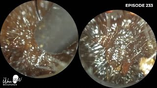 233  Bilateral Ear Wax Removal using the WAXscope®️ [upl. by Ralat99]