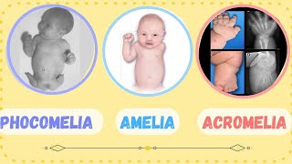 ACROMELIA  PHOCOMELIA  AMELIA  SHORT LIMB ABNORMALITIES  CONGENITAL MALFORMATION [upl. by Eileek]