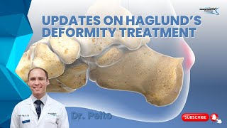 Updates on Haglunds deformity treatment [upl. by Gent]