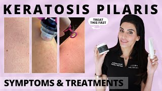 Keratosis Pilaris Causes Symptoms amp Treatments from a Dermatologist keratosispilaris chickenskin [upl. by Weldon]