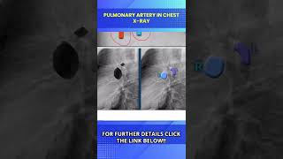 Chest X Ray Lateral View Normal amp Positioning Chest X Ray Kaise Hota Hai [upl. by Geesey]