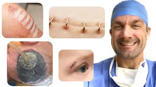 How do I close surgical wounds What are my options [upl. by Vullo]