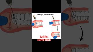 Incisive nerve block [upl. by Nomead104]