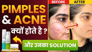 Want CLEAR Skin Watch This Acne Treatment Now  Dr Megha Chaturvedi [upl. by Oberg863]